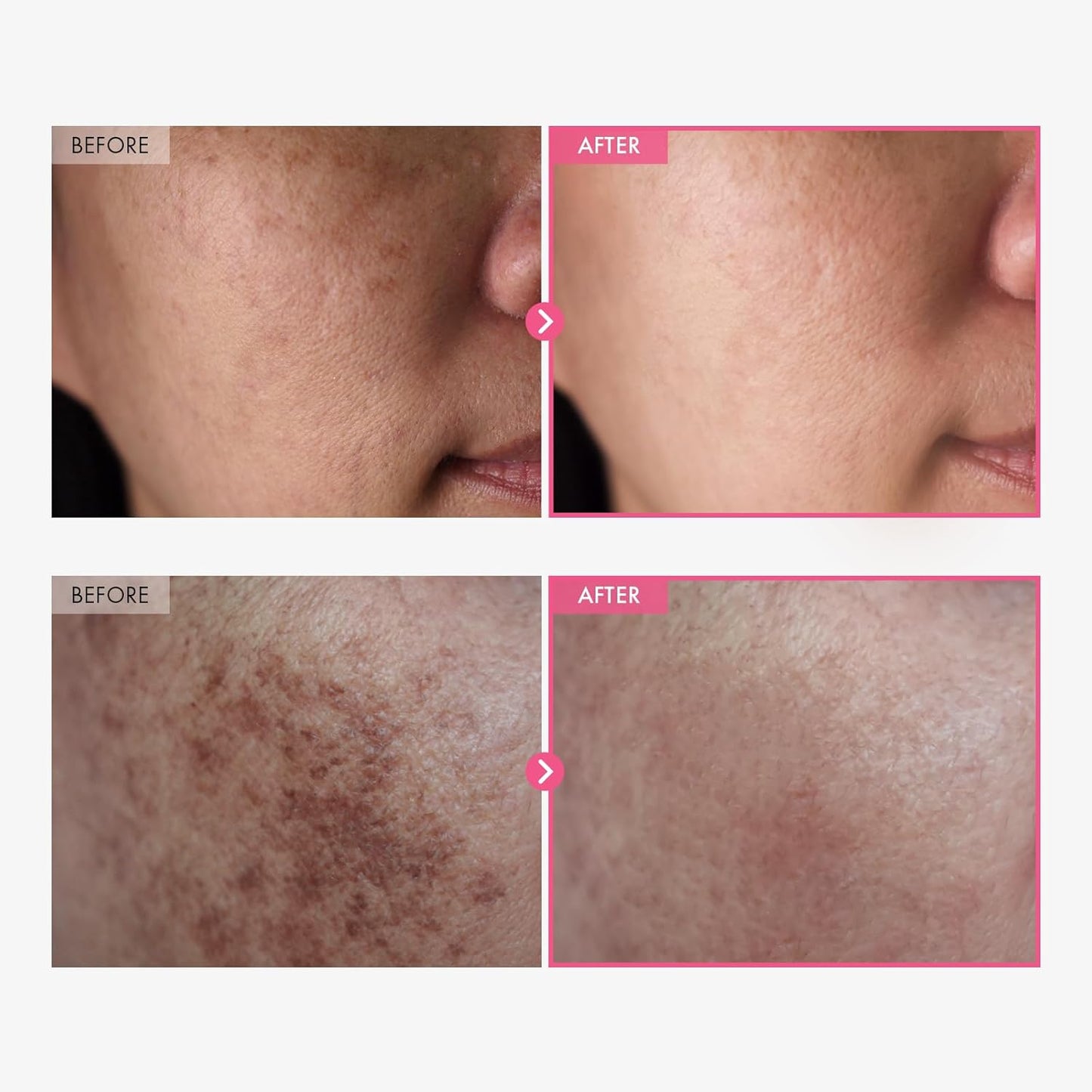 Merluna™ - Arbutin Skincare Cream